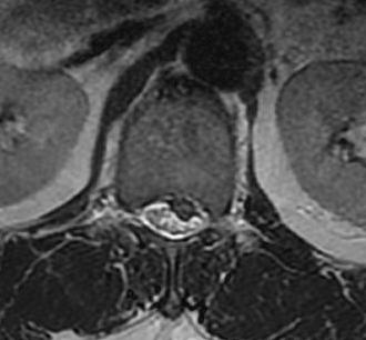 Central Lumbar Disc Herniation